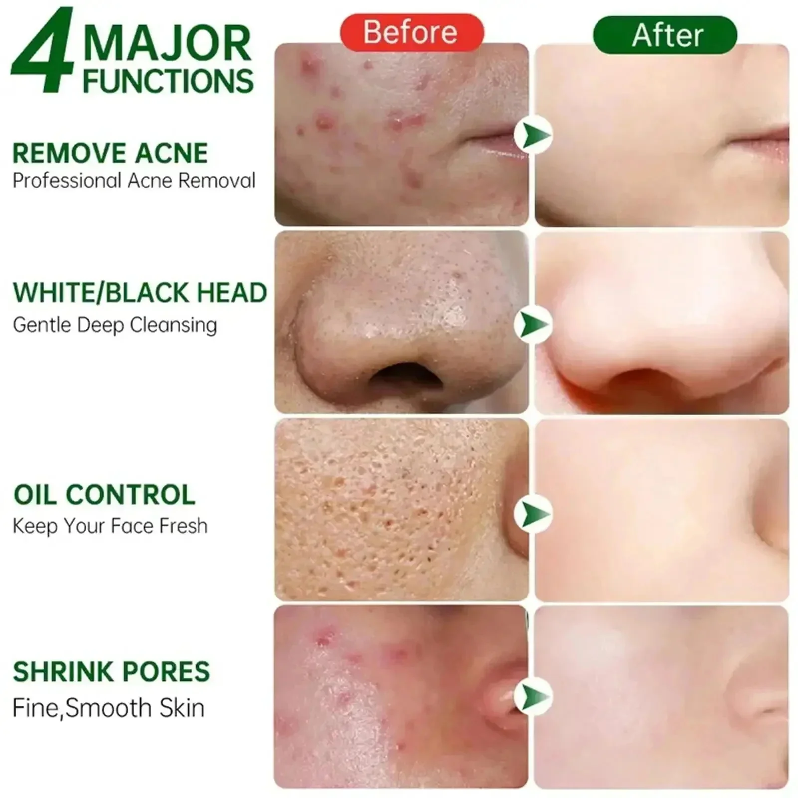 Krim Pembersih Pori Asam Salis - Salicylic Acid Blackhead Remover ulasan dan harga