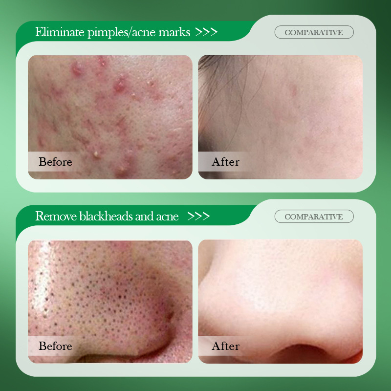 Krim Perawatan Jerawat Asam Sa - Salicylic Acid Blackhead Remover ulasan dan harga